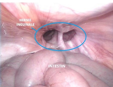 Inguinal Hernia Surgery | Dr. Bruto Randone | Digestive Surgeon | Paris - France
